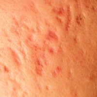 Post-acne,,Scars,And,Red,Festering,Pimples,On,The,Face,Of Post-acne,,Scars,And,Red,Festering,Pimples,On,The,Face,Of