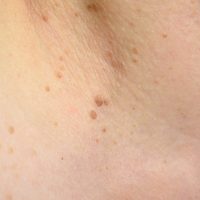 Senile,Warts,On,Neck,And,Breast,Close,Up Senile,Warts,On,Neck,And,Breast,Close,Up